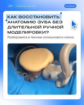 Силиконовый ключ и А-силикон: точная анатомия жевательной поверхности.